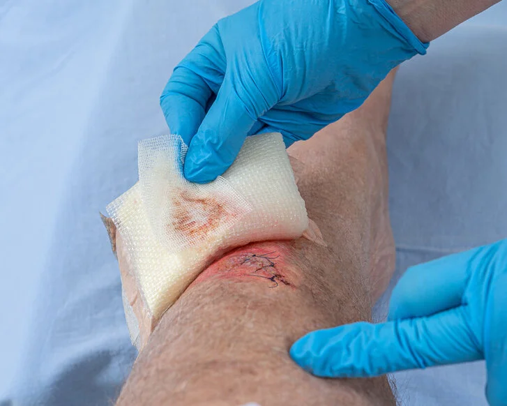 Medical Adhesive-Related Skin Injuries (MARSI), Hautschädigung unter einer Wundauflage