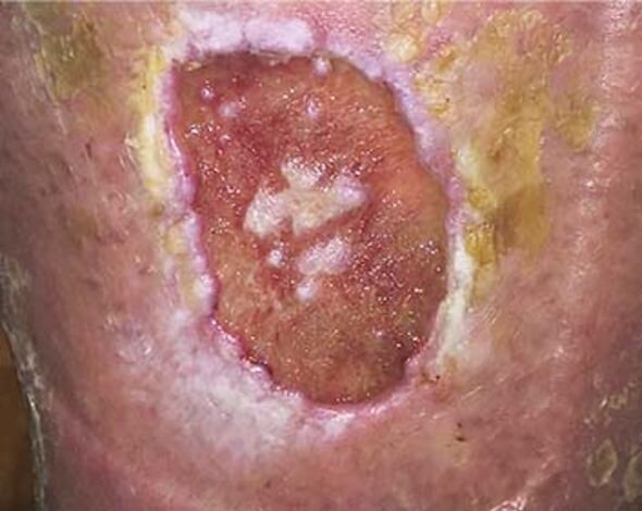 Biofilm auf einer Wunde Biofilm