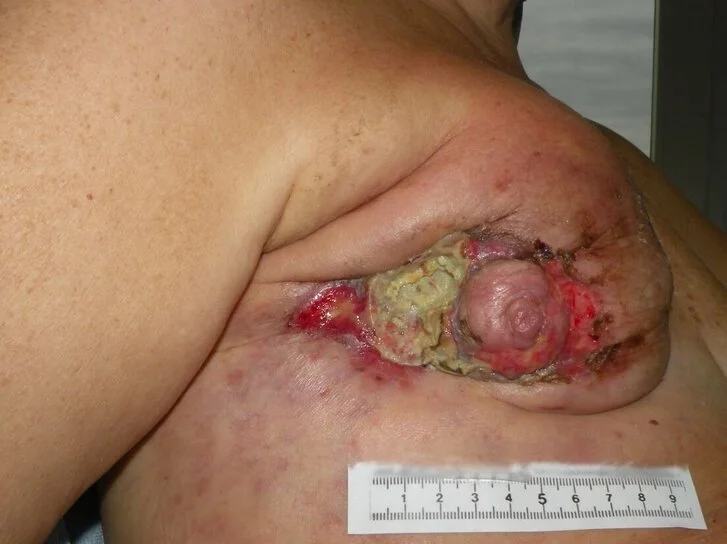 Fallbeispiel Fallbeispiel: Palliative Versorgung eines Exulzerierenden Tumors – Ausgangssituation