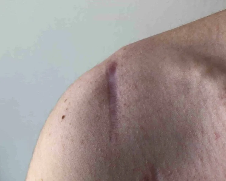 Abgeheilte OP-Wunde mit zurückgebliebener Narbe Narben – Physiologie, Narbenprophylaxe und Narbenpflege