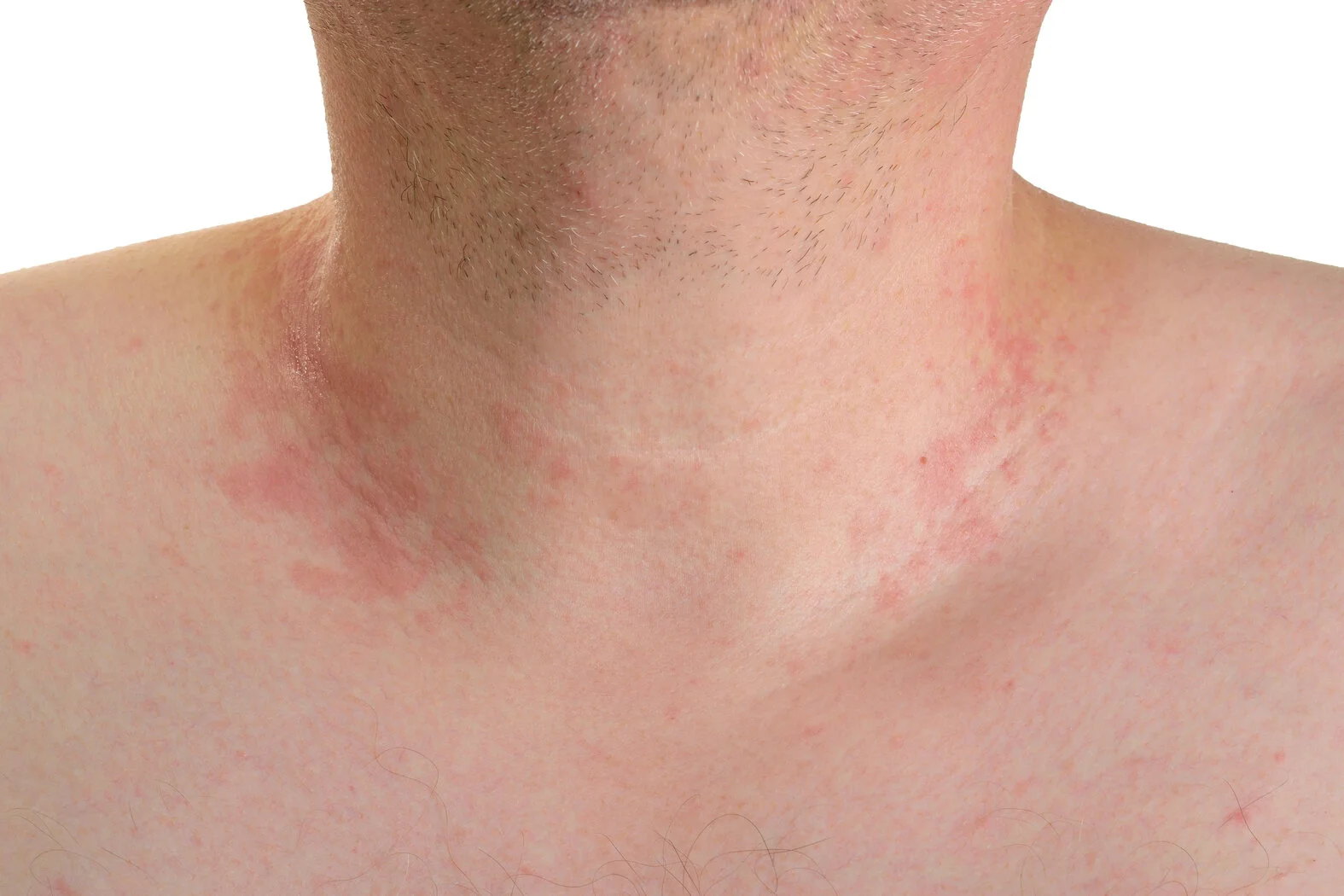 Erythrasma (Zwergflechte) Symptome, Diagnose und Therapie
