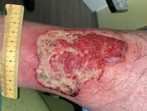 Pyoderma gangraenosum Tag 1