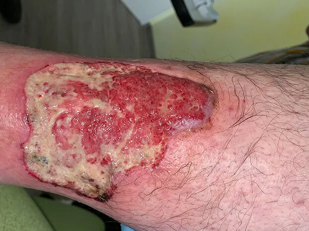 Pyoderma gangraenosum Tag 1