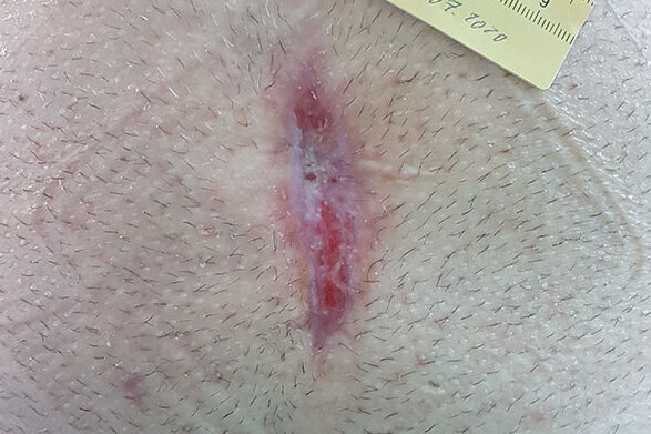 Nahtdehiszenz am Bauch