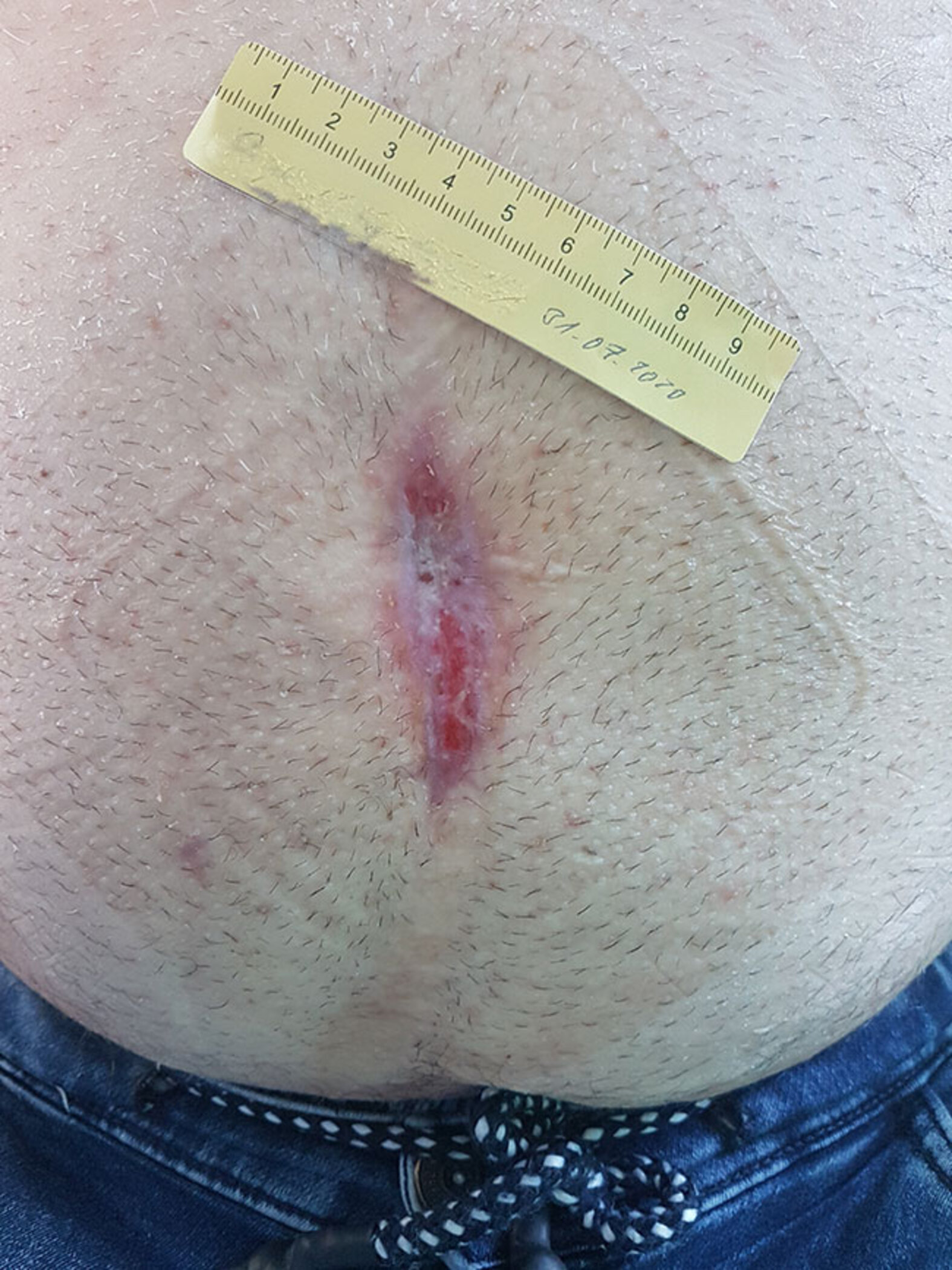 Nahtdehiszenz am Bauch
