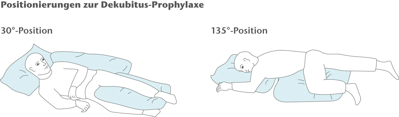 Positionierungen zur Dekubitusprophylaxe: 30°- und 135°-Lagerung