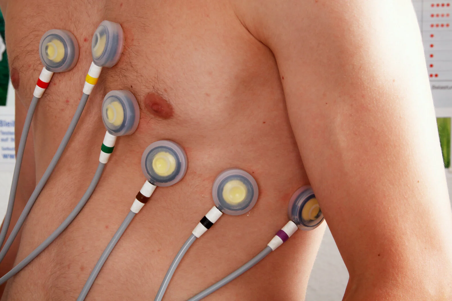 EKG-Saugelektroden zur Ableitung an der Brustwand