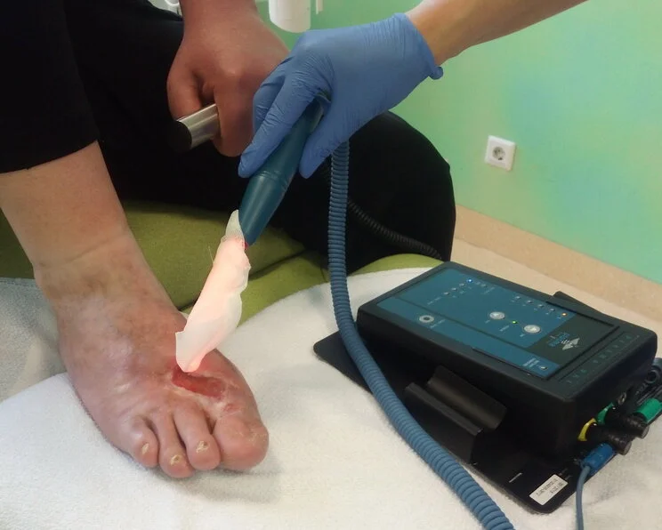 Wundbehandlung mit kaltem Plasma, chronische Fußwunde Kaltplasmatherapie