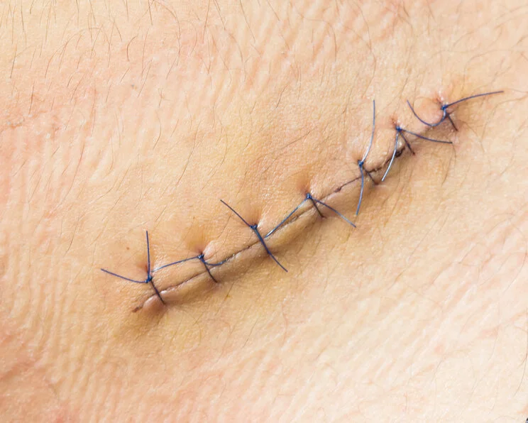 Primär und sekundär heilende Wunden