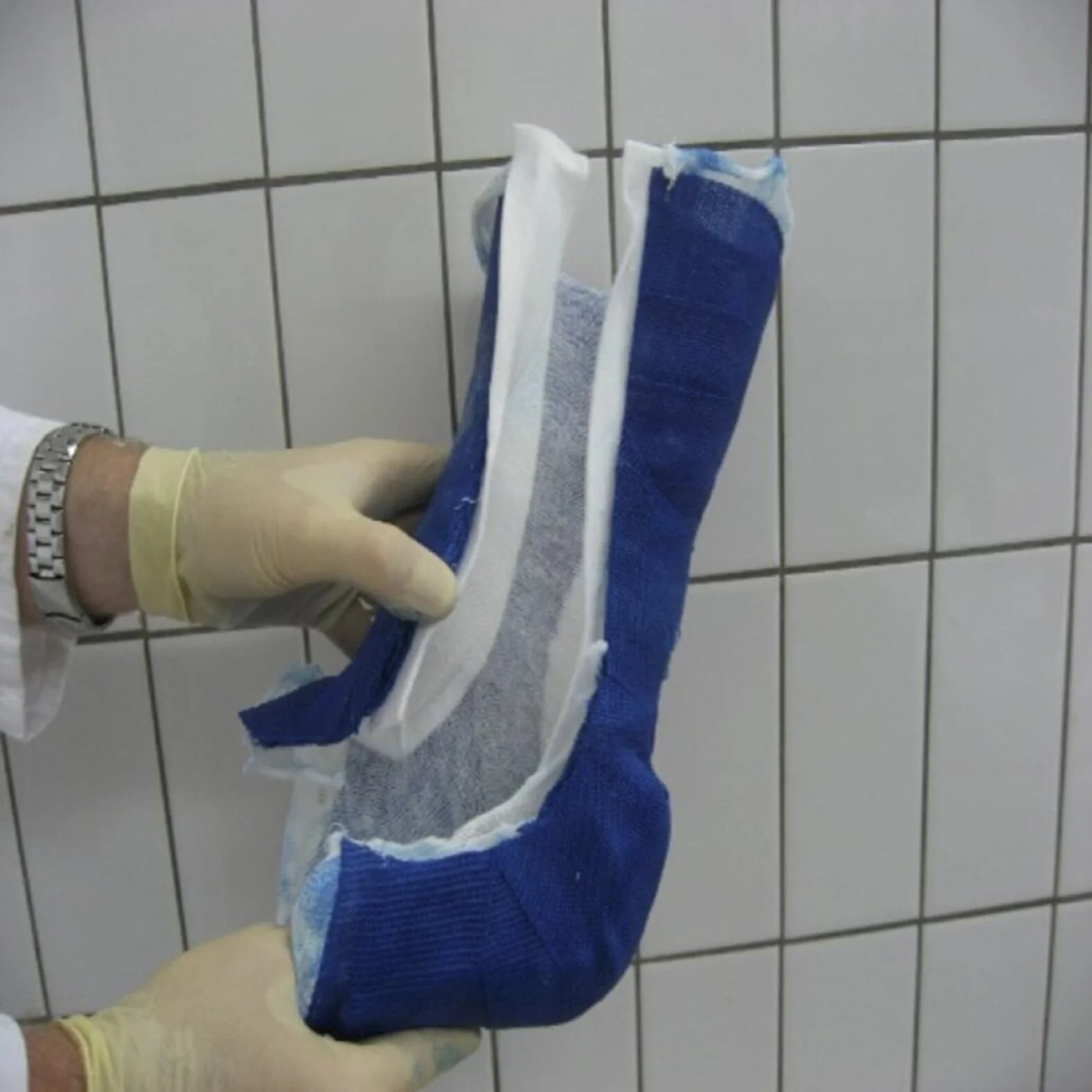 CharcotFuß oder CharcotArthropathie beim Diabetischen Fuß