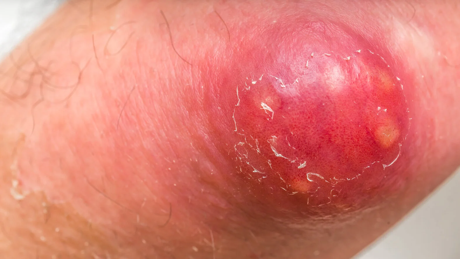 Eiter Eitrige Wunden und Entzündungen, Behandlung