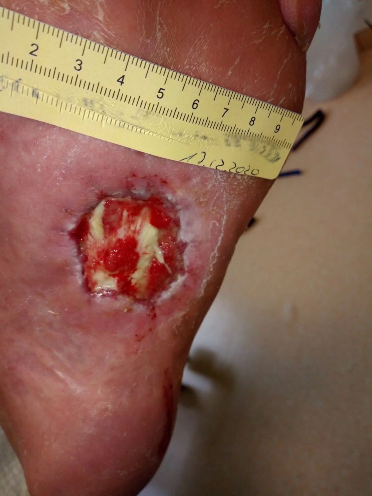  Diabetisches Fußulcus mit Granulationsgewebe
