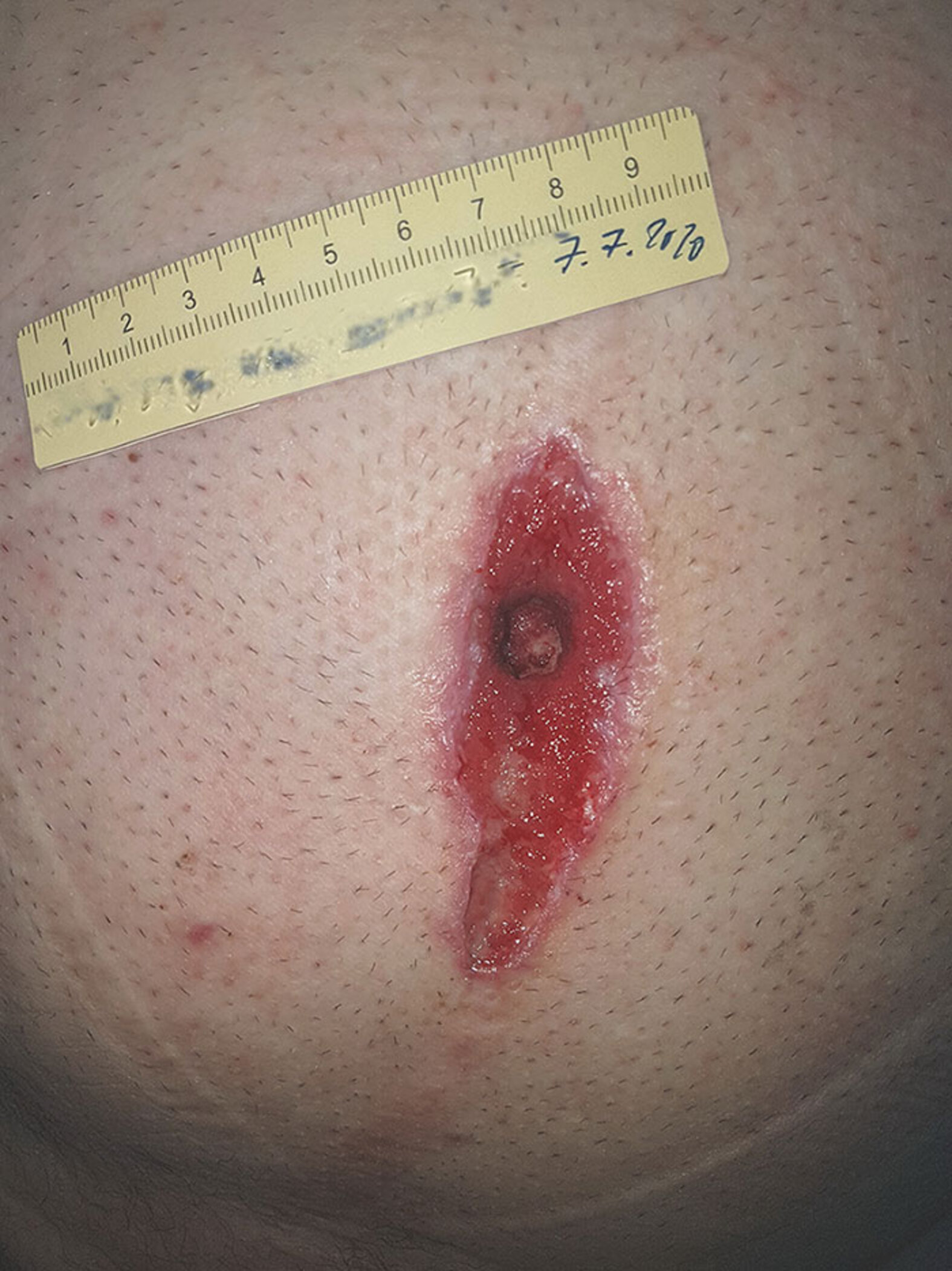Nahtdehiszenz am Bauch