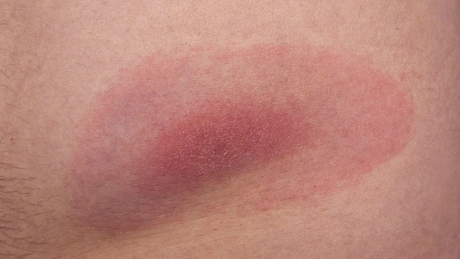 Lyme-Borreliose, typische ringförmige Hautrötung