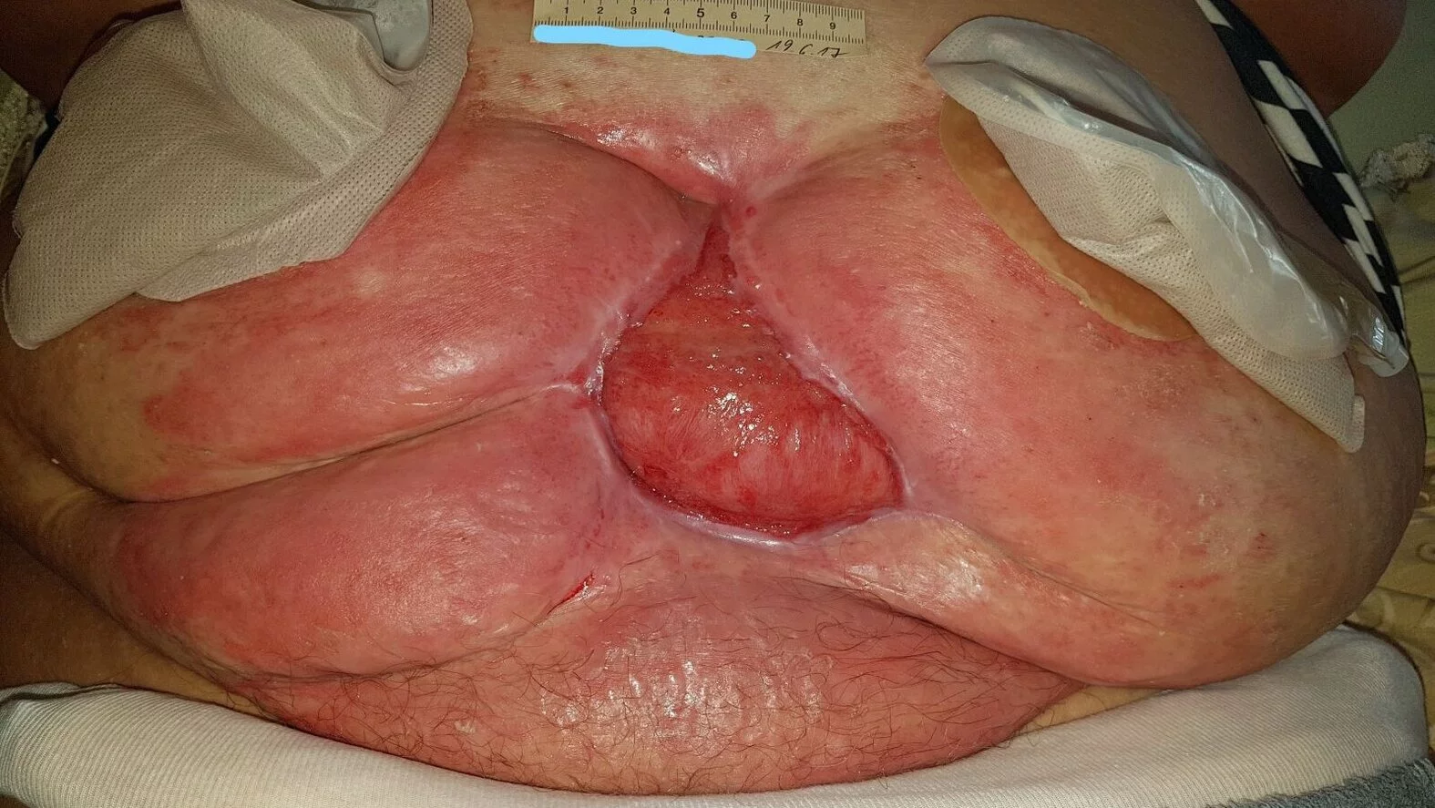 Bauchwunde mit Stomaanlagen – nach 10 Wochen