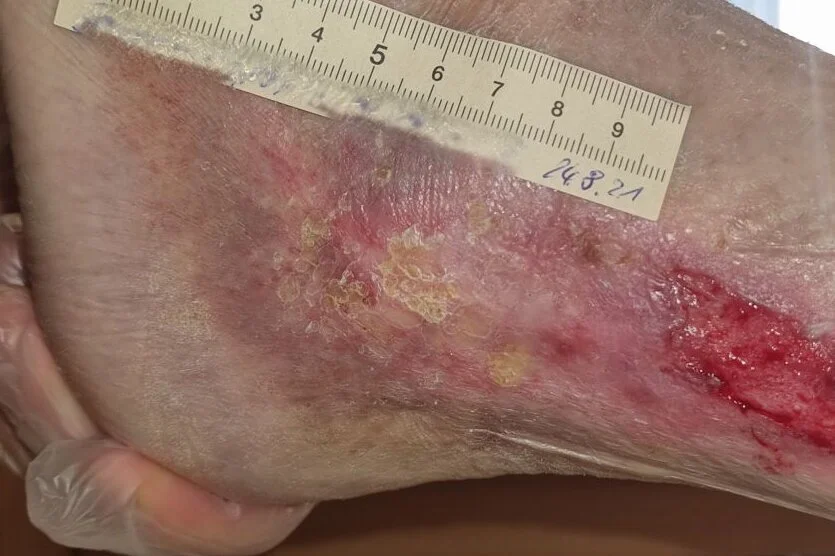 Ulcus cruris mixtum am linken Knöchel – nach 7 Monaten