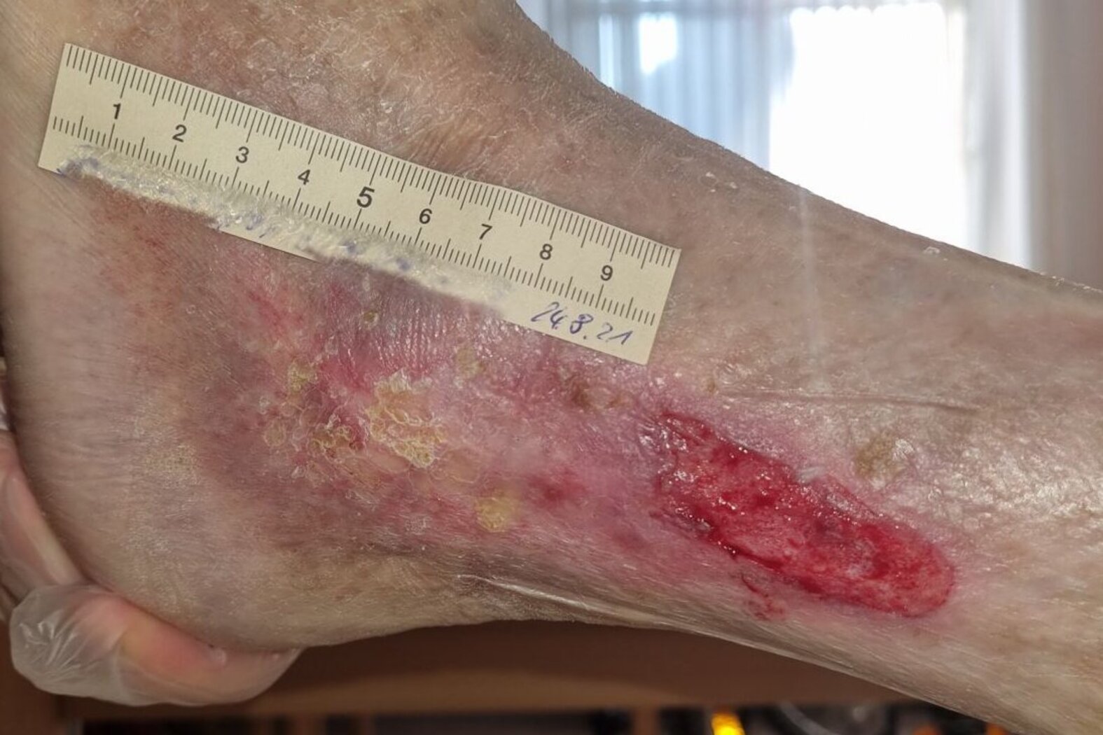 Ulcus cruris mixtum am linken Knöchel – nach 7 Monaten