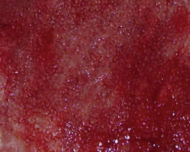 Granulationsgewebe Granulationsgewebe