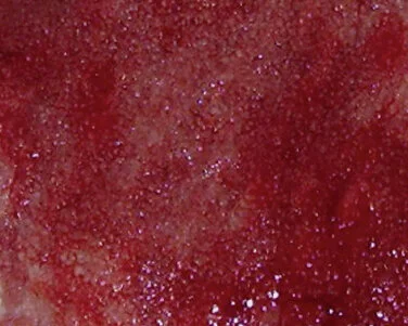 Granulationsgewebe Granulationsgewebe