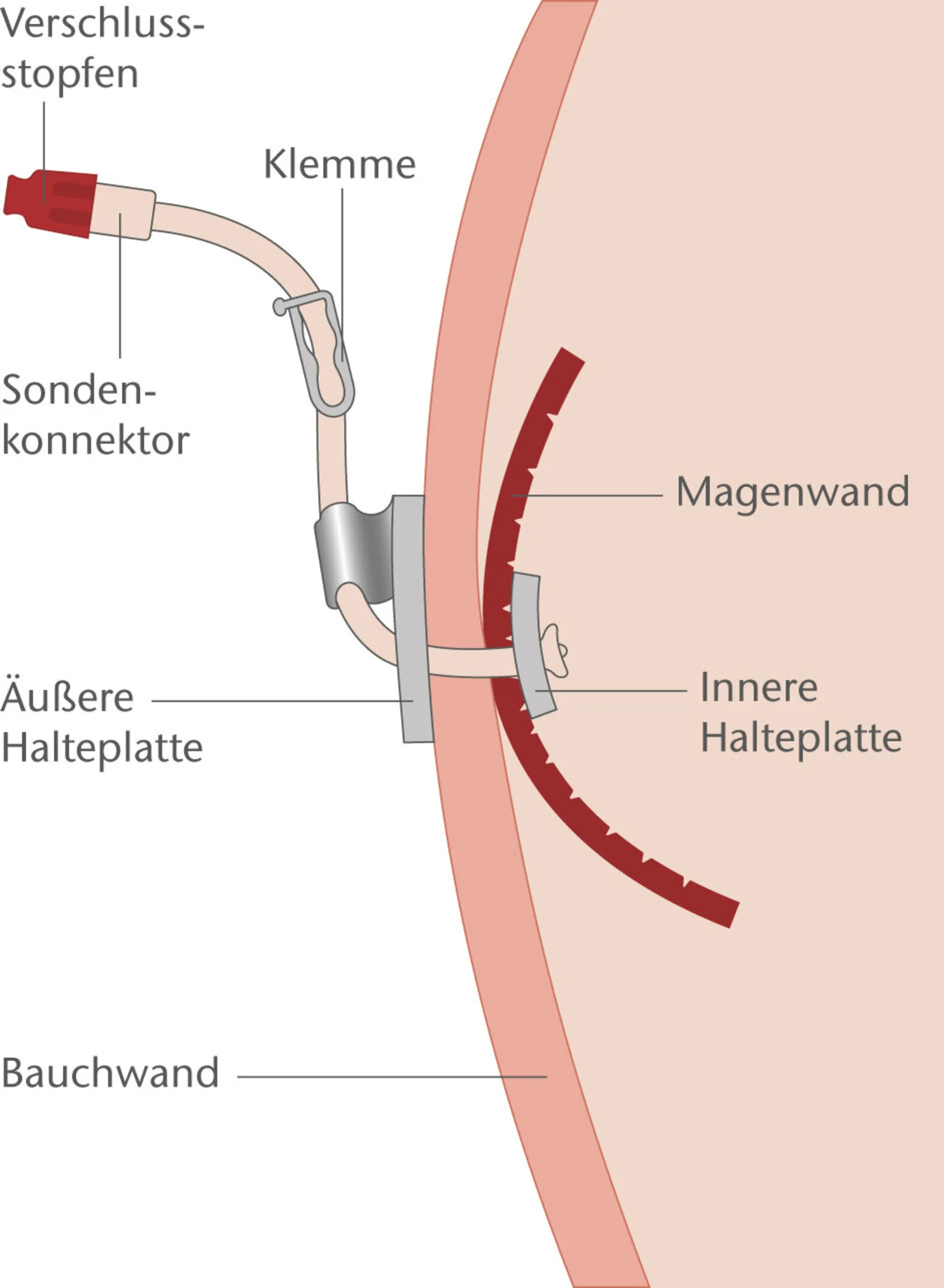 Darstellung einer PEG-Sonde