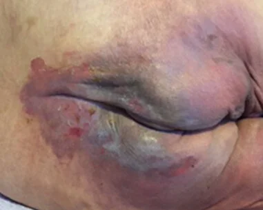 Inkontinenz-assoziierte Dermatitis IAD - Inkontinenz-assoziierte Dermatitis