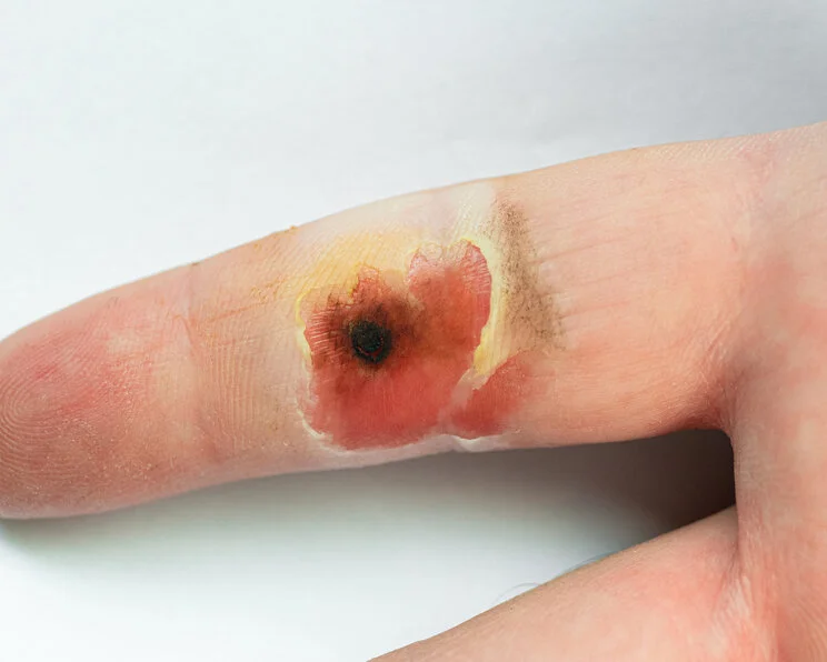 Verätzung: Chemische Verletzung am Finger Chemische Verletzungen durch Laugen