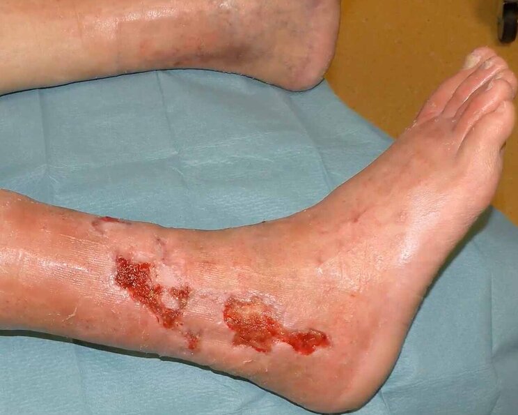 Ulcus Cruris Arteriosum am Unterschenkel Ulcus cruris arteriosum