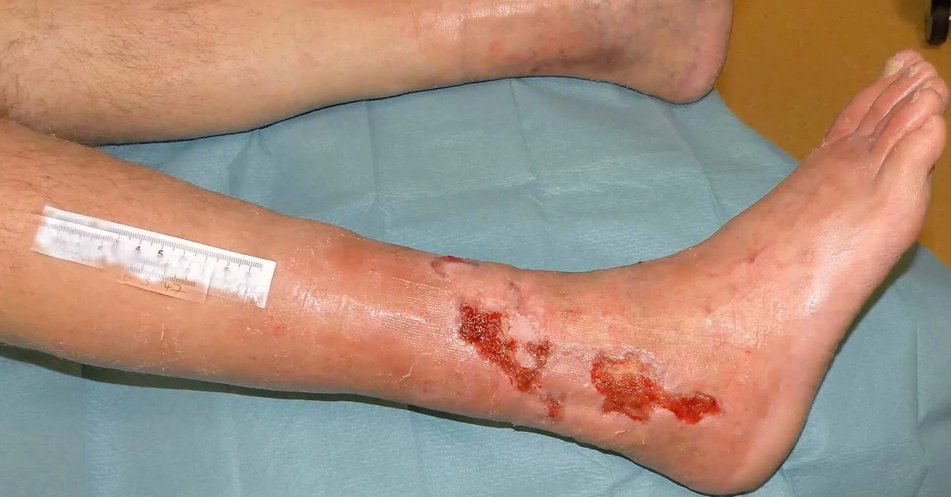 Wie entsteht Ulcus cruris Arteriosum?
