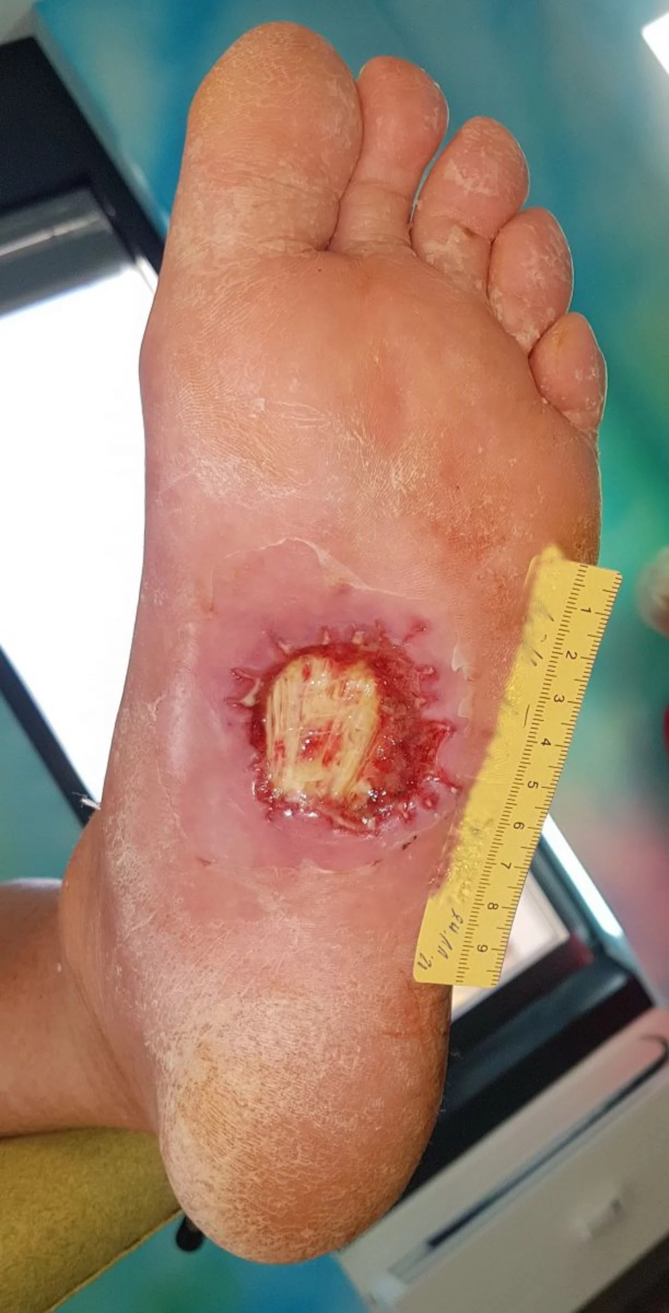 Diabetisches Fußulcus, ca. 5 cm breit, 4,5 cm lang und ca. 1,5 cm tief