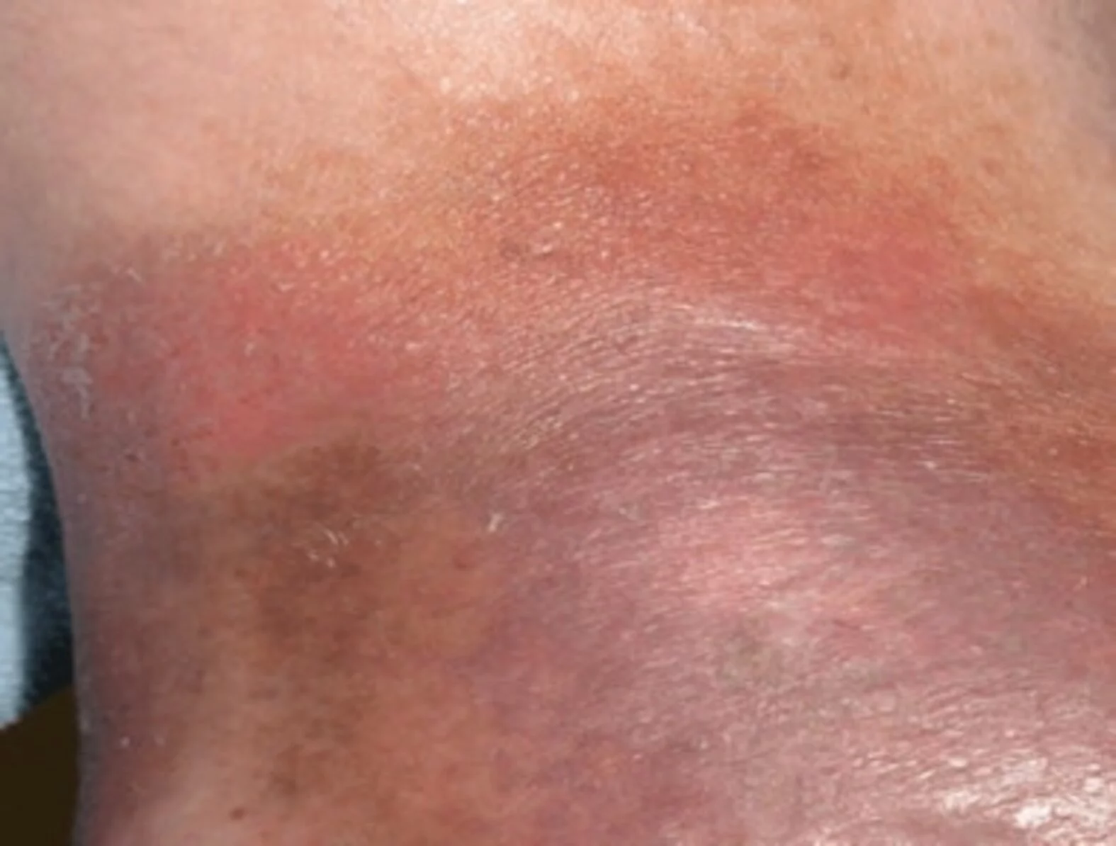 Typische Hautveränderung bei Ulcus cruris venosum