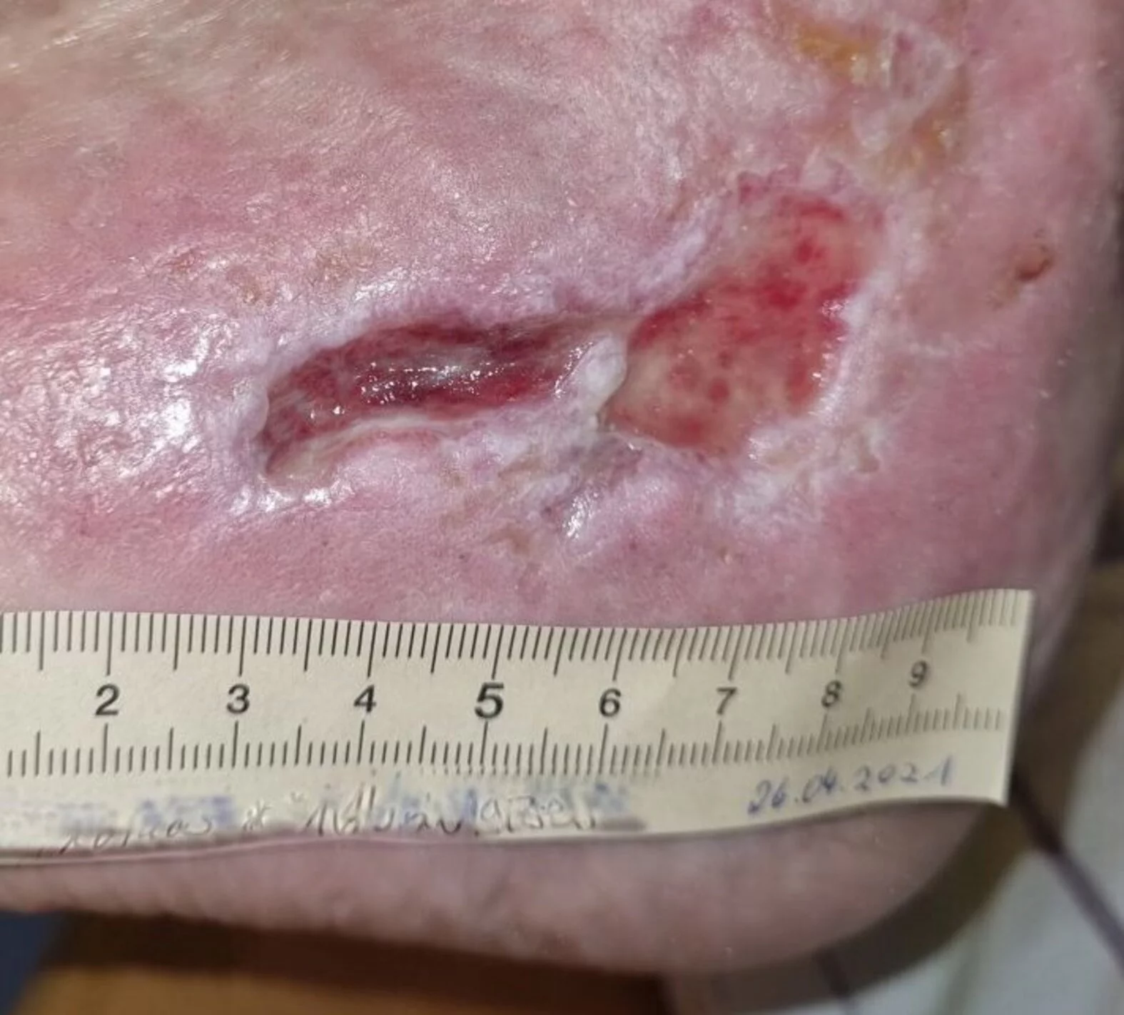 Ulcus cruris mixtum am linken Knöchel – nach 3 Monaten