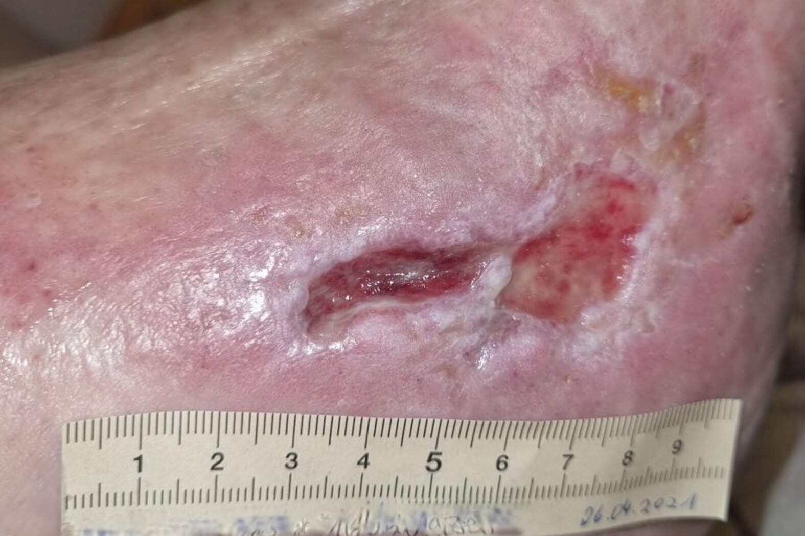 Ulcus cruris mixtum am linken Knöchel – nach 3 Monaten