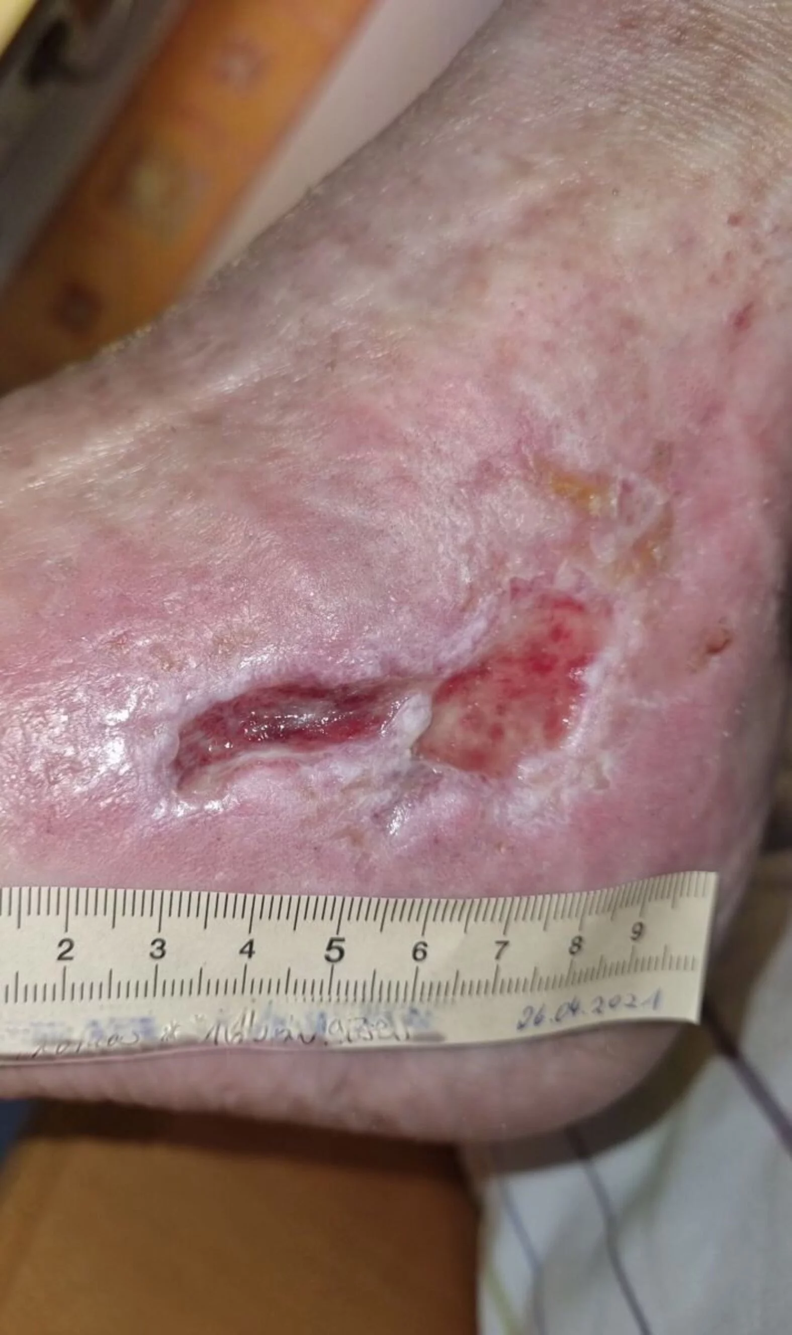 Ulcus cruris mixtum am linken Knöchel – nach 3 Monaten