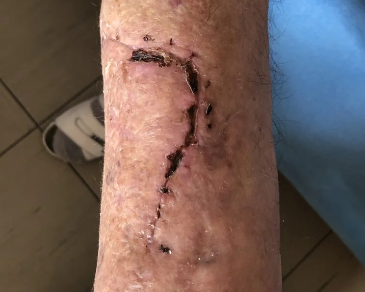 Ablederungswunde, verheilt, bei Altershaut Ablederungswunde (Décollement)