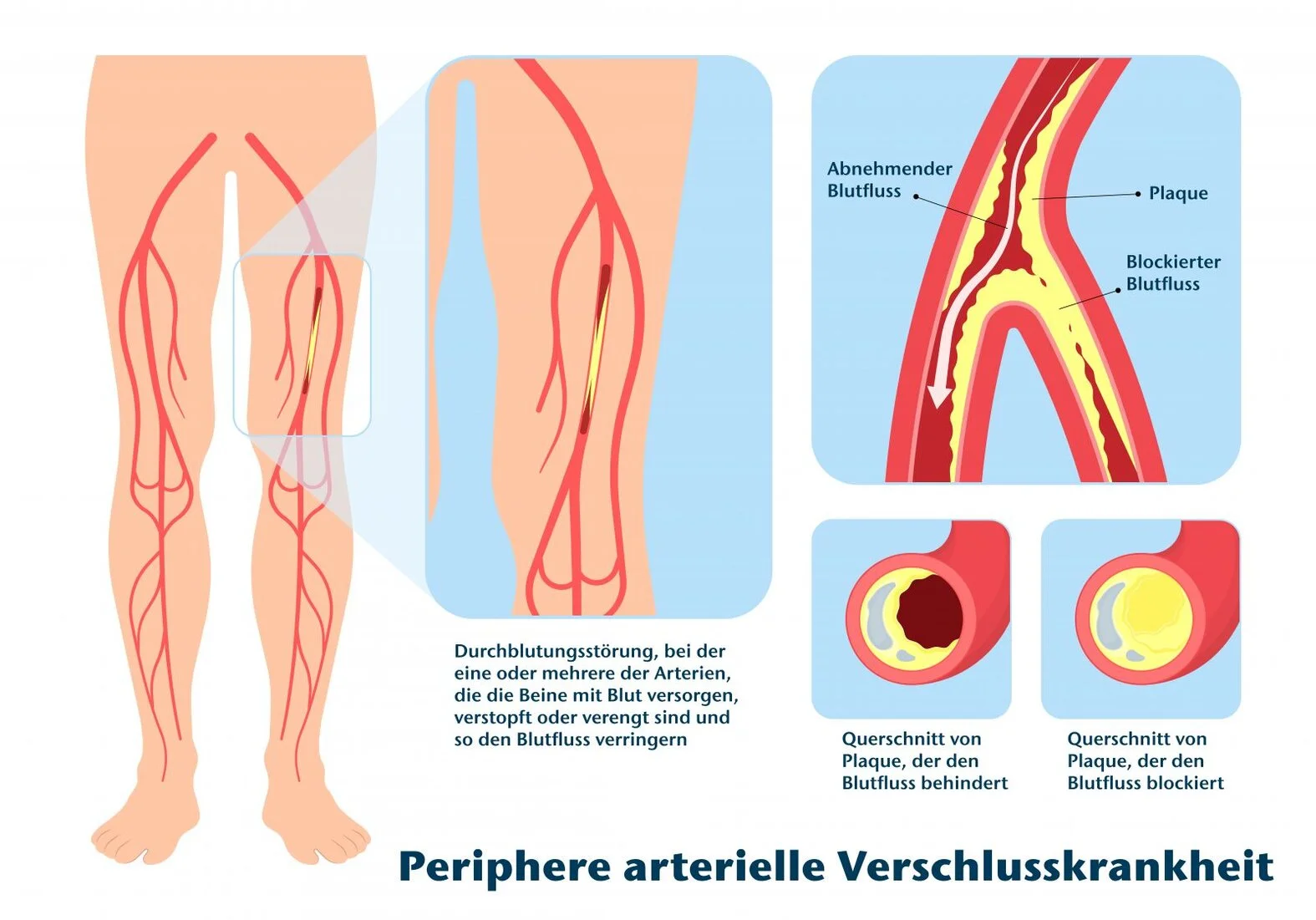 pAVK: Schematische Darstellung Beine, Arterien