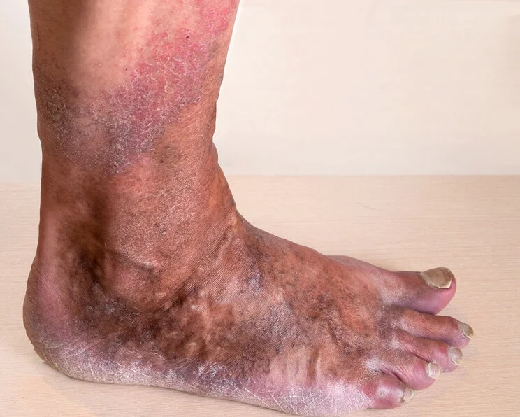 Stauungsdermatitis, Diagnostik Stauungsdermatitis: Ursachen, Symptome und Therapie