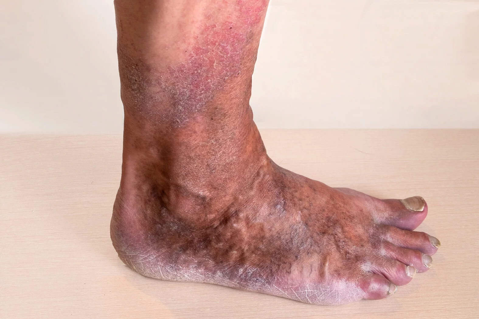 Stauungsdermatitis am Knöchel/Bein, Venenerkrankungen