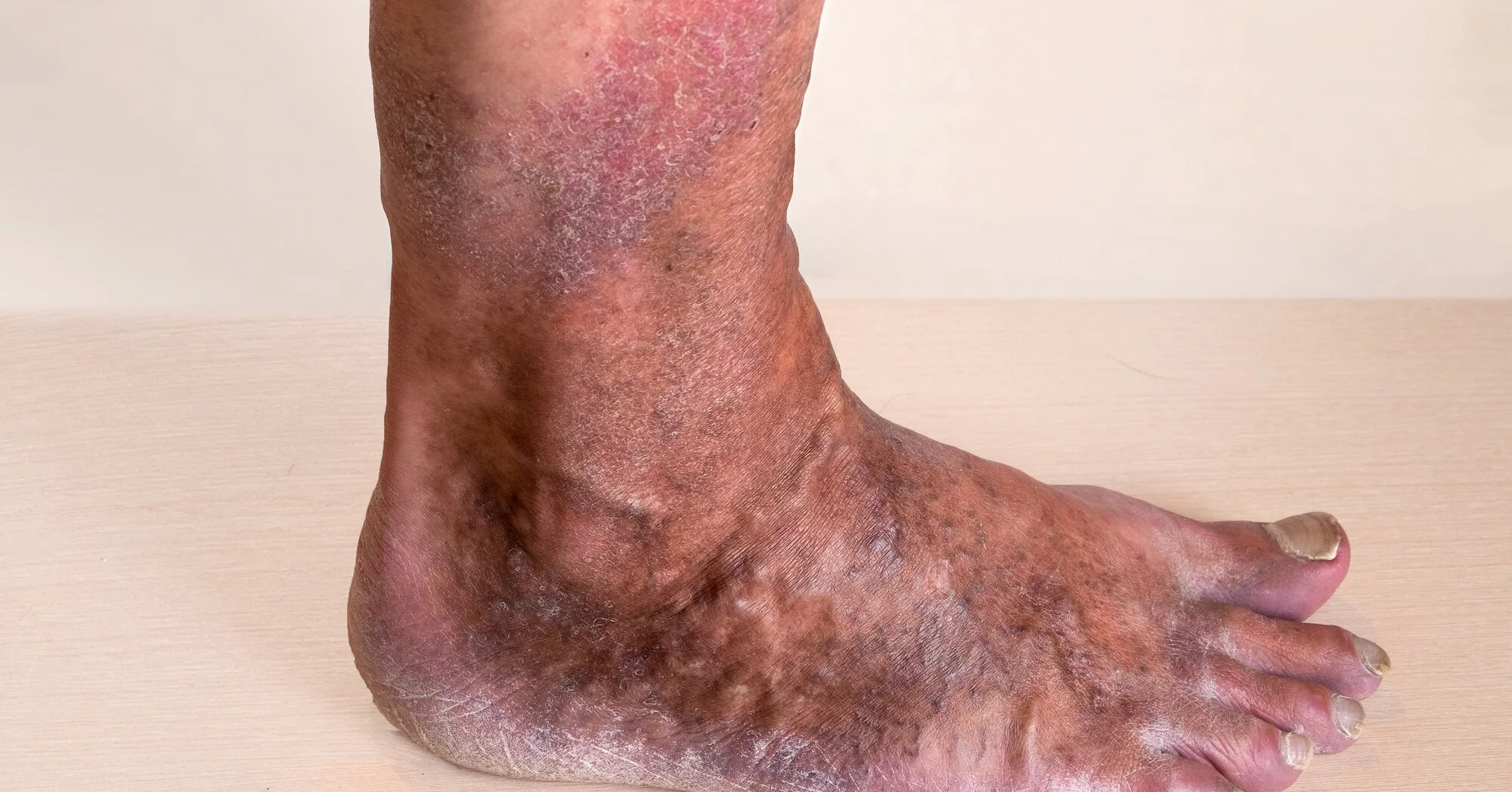 Stauungsdermatitis Ursachen, Symptome und Therapie
