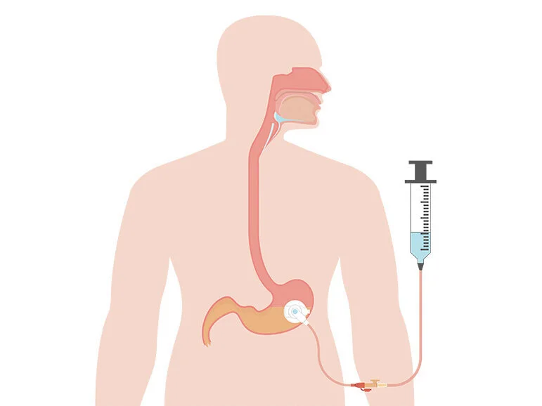 Oberkörper mit PEG-Sonde