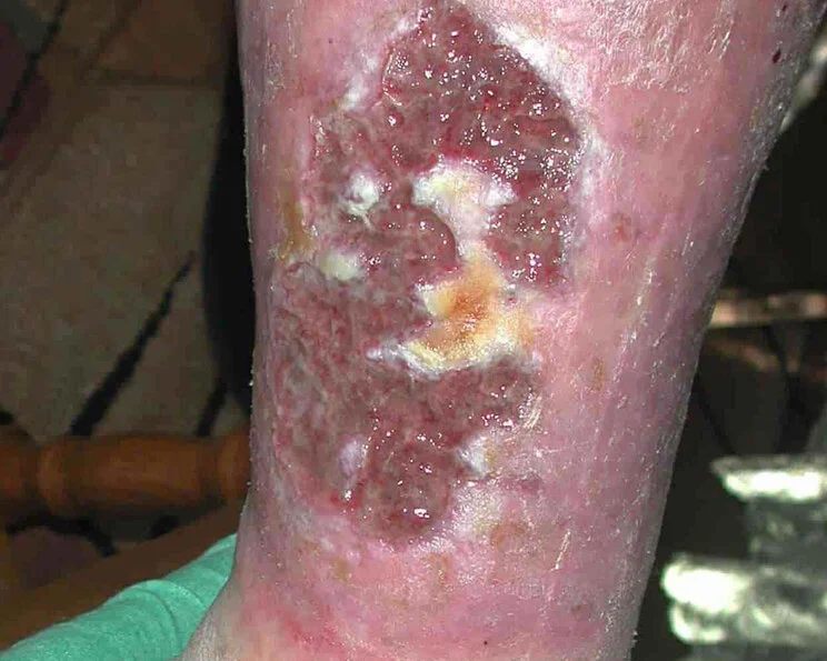 Ulcus cruris venosum Ulzeration