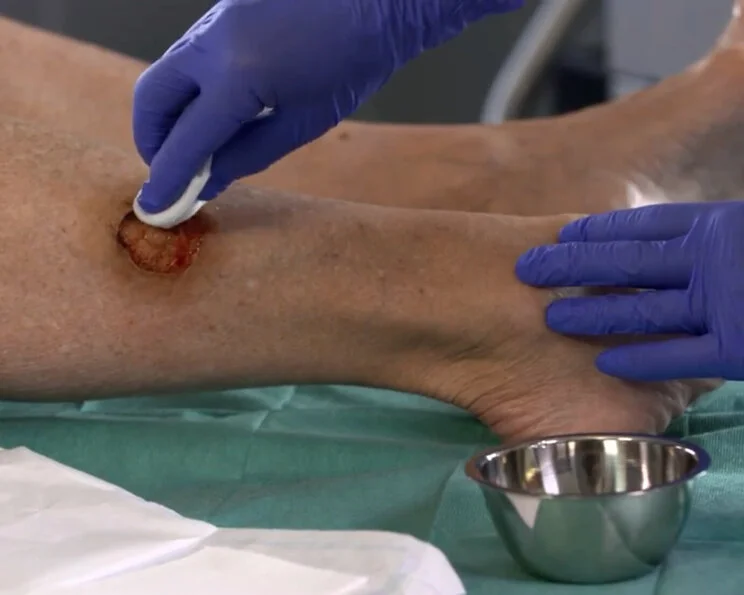 Wundversorgung in der Pflege - Mechanisches Débridement Wundreinigung: Ablauf, Methoden und Fallbeispiele