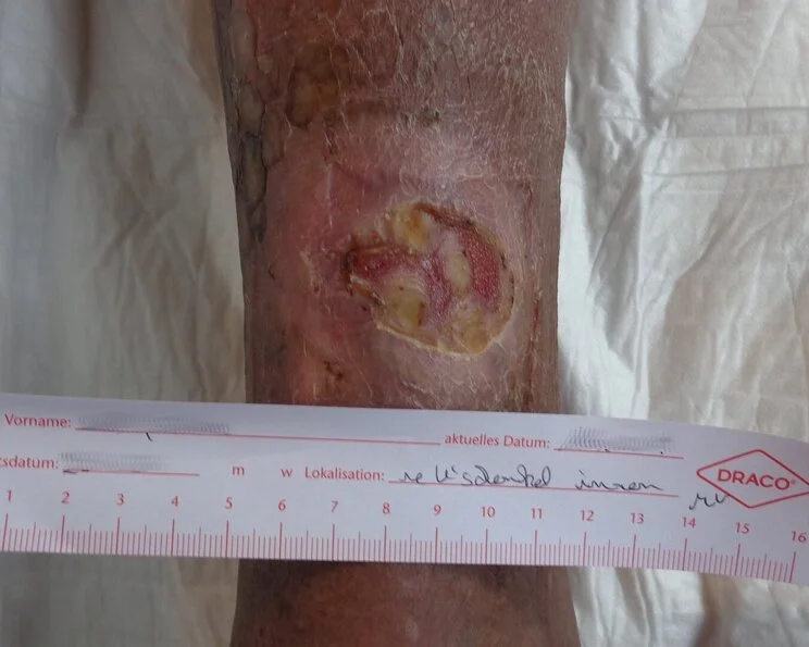 Gelbe Nekrose am Unterschenkel Wundgrund, Wundbett: Diagnostik, Beurteilung, Versorgung