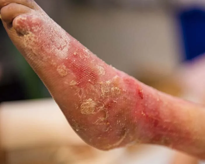Trockene EB-Wunde am Fuß Epidermolysis bullosa – die Schmetterlingskrankheit