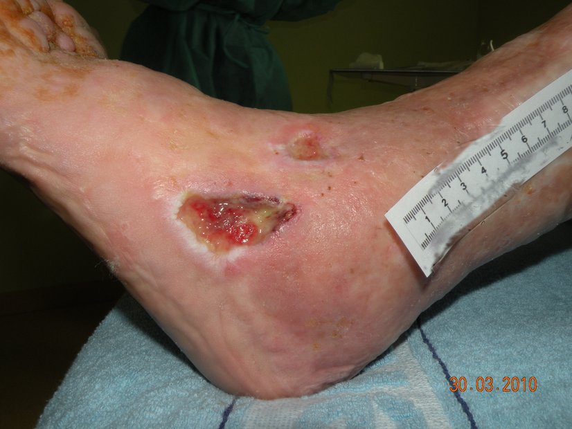 Diabetisches Fußsyndrom Wunde am Knöchel