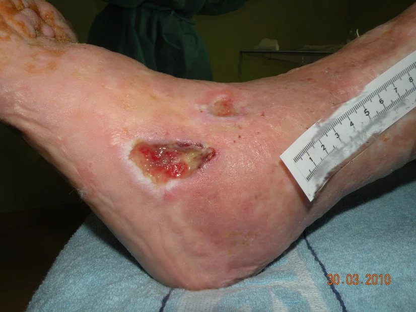 Diabetisches Fußsyndrom Wunde am Knöchel