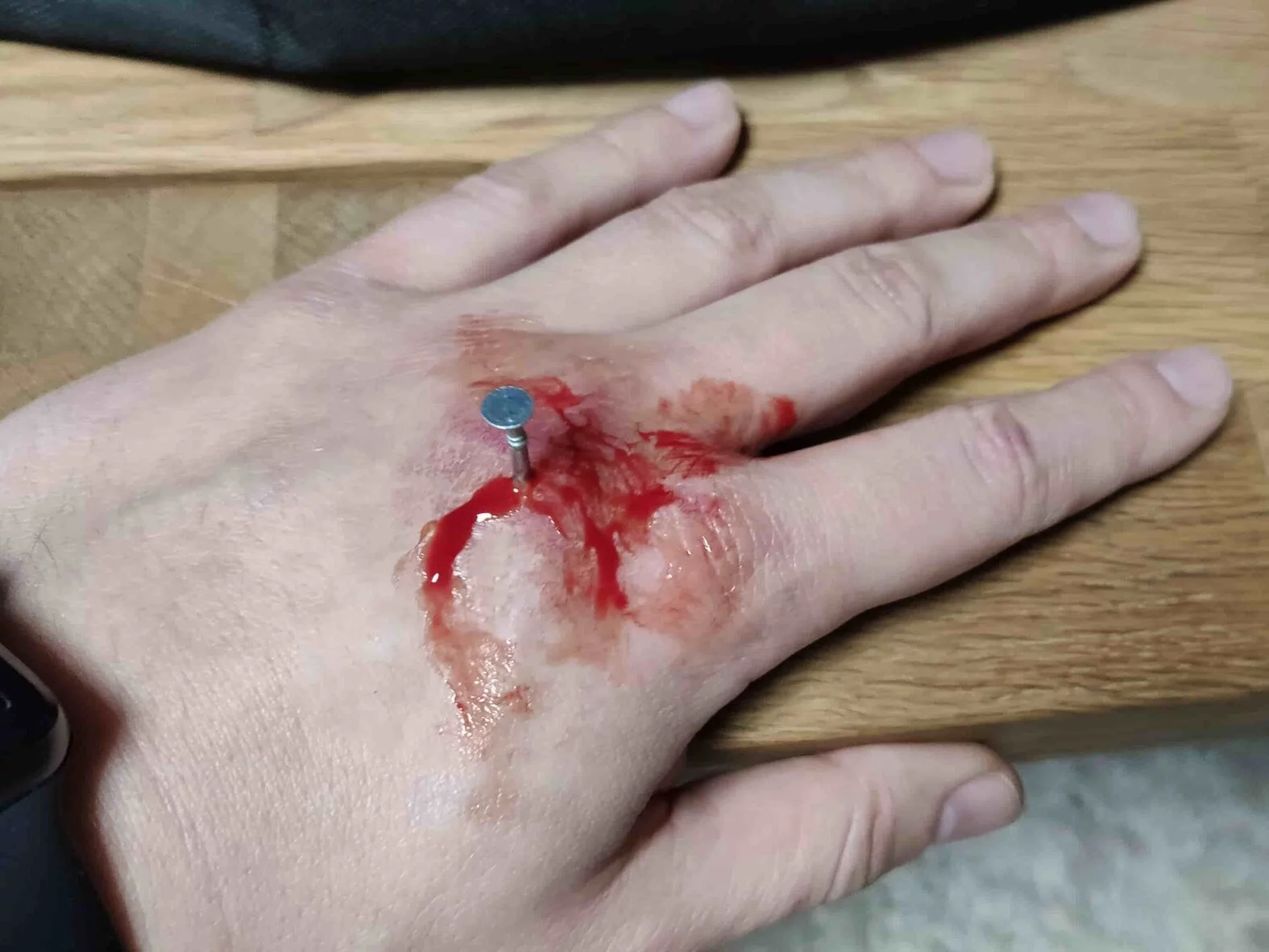 Pfählungsverletzung der Hand druch einen Nagel