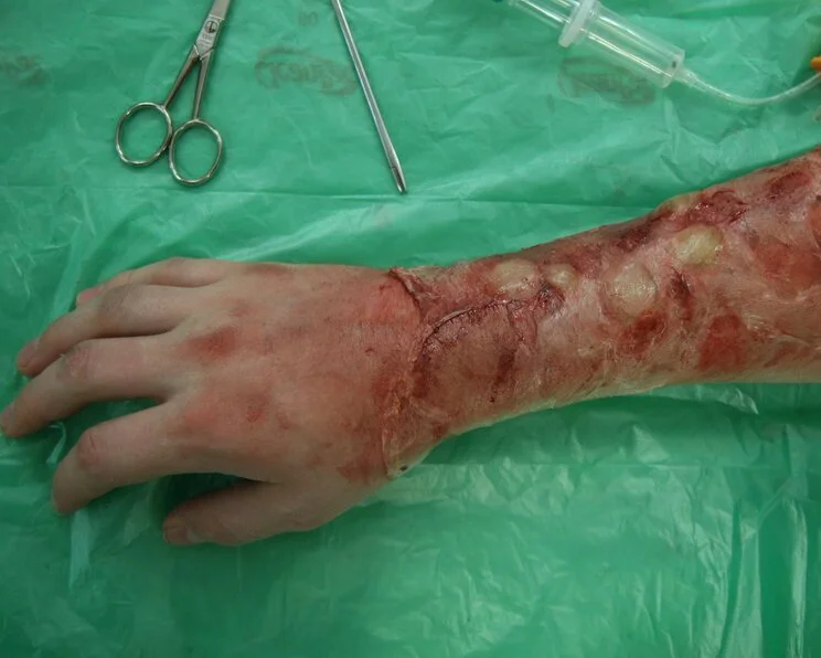 Chemische Wunde am Arm, Säureverätzung Chemische Verletzungen, Verätzungen