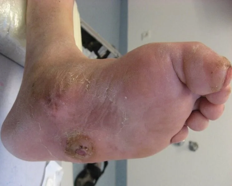 charcot-fuss-ulcus-zehendeformation Diabetisches Fußsyndrom