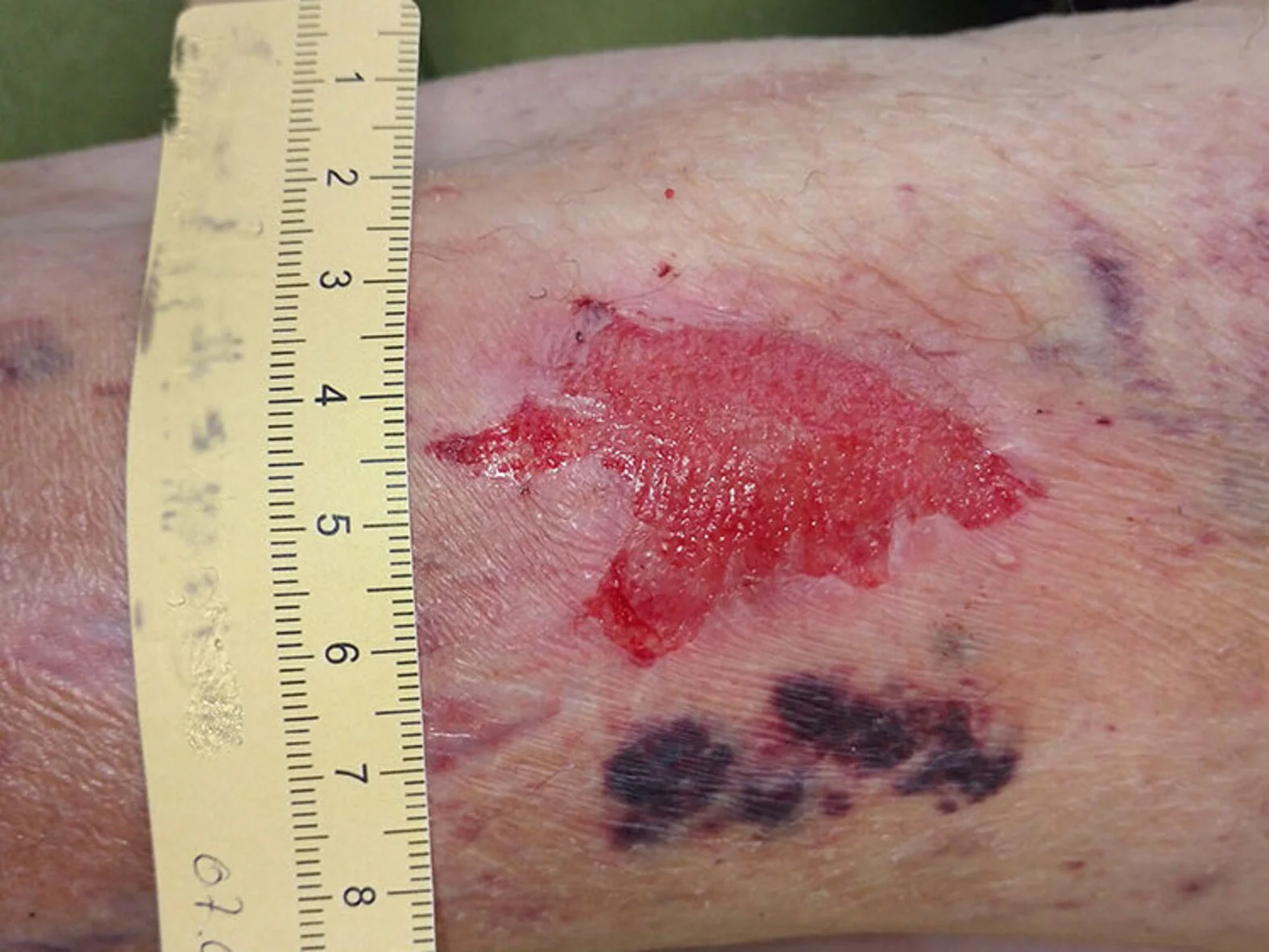 Fallbeispiel Multiple Ulzera auf fragiler Haut (chronische Wunde)