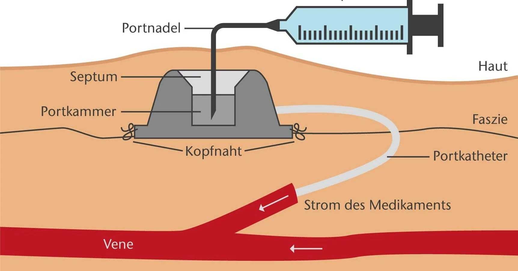 Wann muss ein Port entfernt werden?